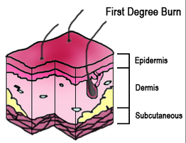 First Degree Burn