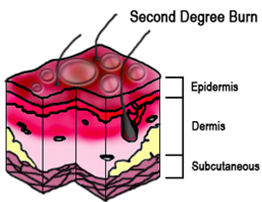 First Degree Burn